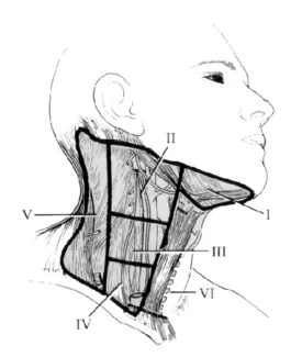Diagram of the neck lymph node regions which would often be examined for metastatic disease: